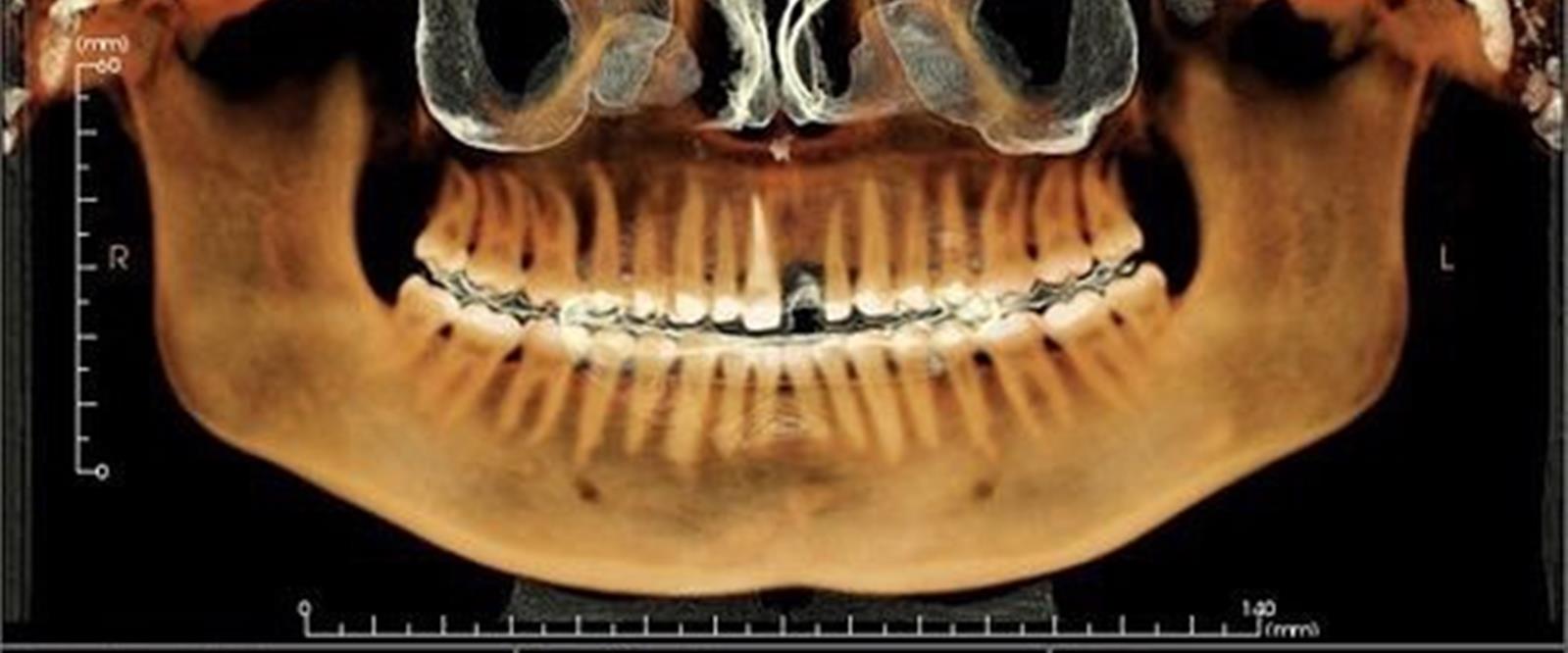 اسکن سه بعدی فک و صورت cbct