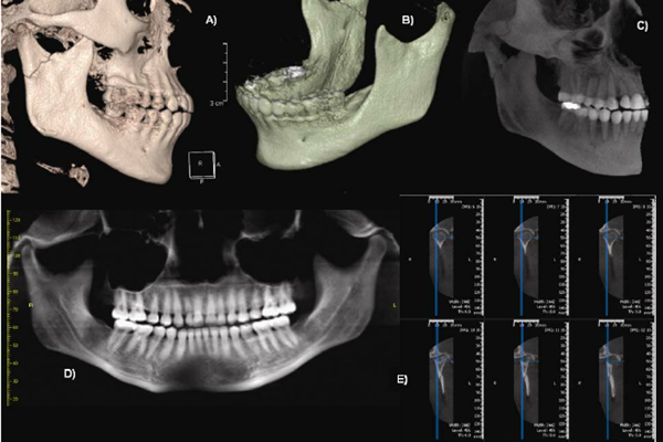 مفصل گیجگاهی فکی (TMJ)