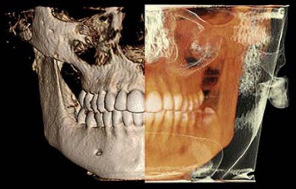 اسکن سه بعدی فک و صورت CBCT